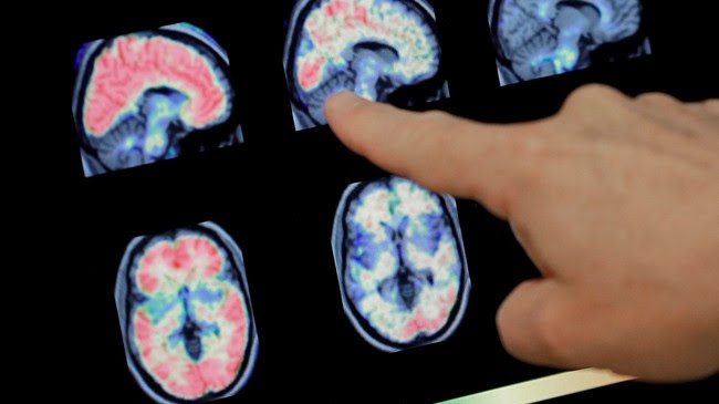 A doctor looks at Alzheimer's in a PET brain scan. Photo by: AP Photo/Matt York