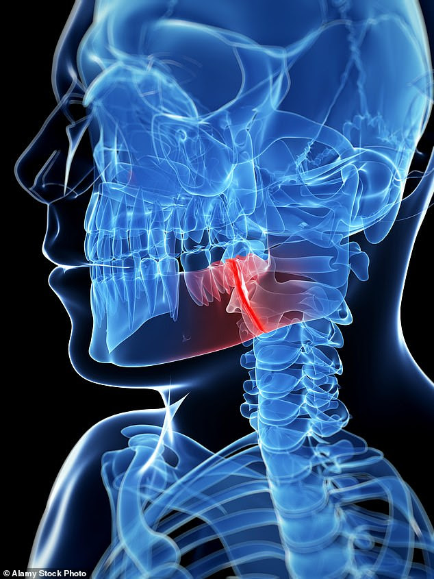 Radiotherapy to the head and neck, given for tongue, throat and nose cancers, can lead to problems with blood vessels connected to the lower jaw