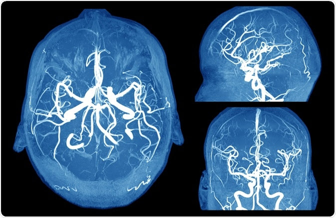 Brain Aneurysm