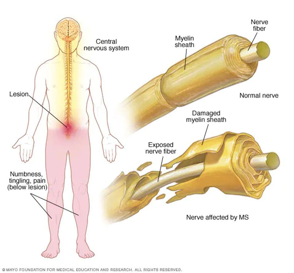 Comparison of normal nerve versus MS demyelinated nerve sheath