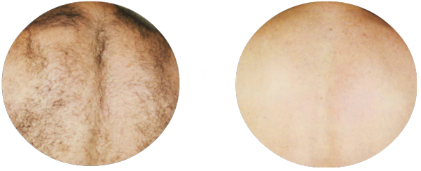 Laser hair removal for men results