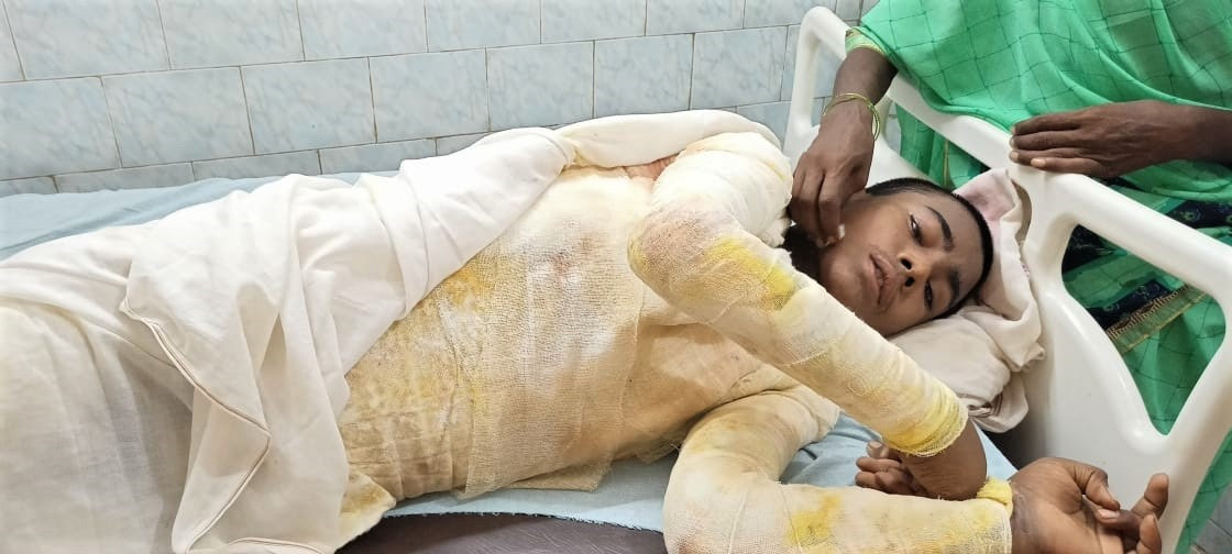  Attack in Bihar state, India left Nitish Kumar, 14, with burns on 65 percent of his body. (Morning Star News)
