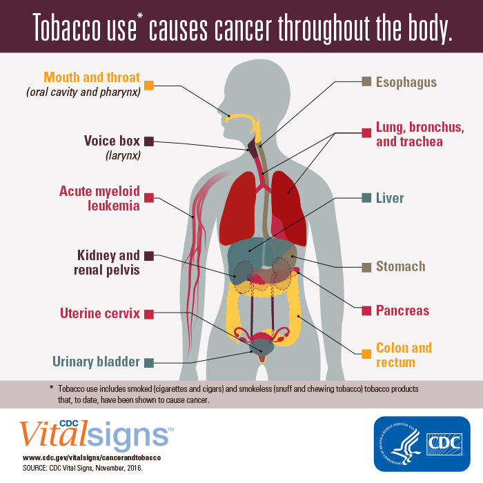 CDC Vital Signs: Cancer and Tobacco Use