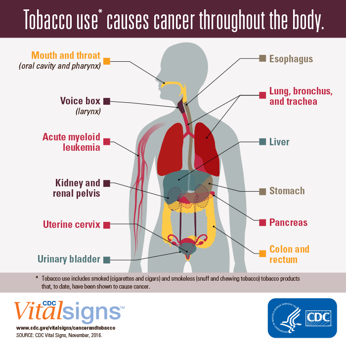 CDC Vital Signs: Cancer and Tobacco Use CDC Vital Signs: Cancer and Tobacco Use