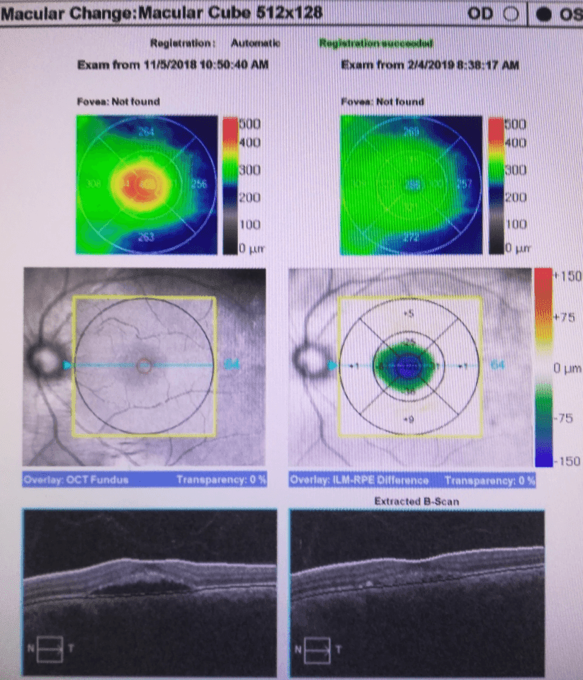 Macular Edema reduction in 3 months