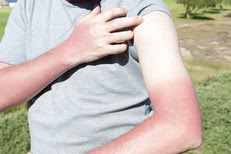 Man with sunburn