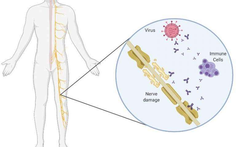 Rise in Guillain-Barré syndrome following AstraZeneca vaccine