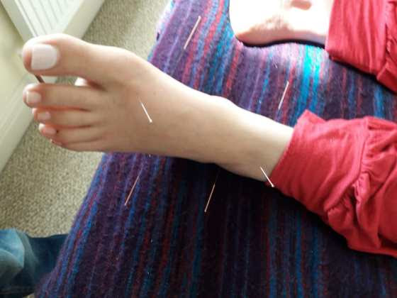 acupuncture