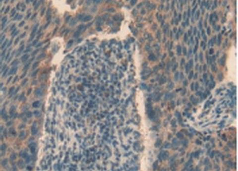 IHC-P analysis of Human Esophagus Cancer Tissue, with DAB staining