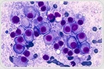 Screening strategies could reduce multiple myeloma prevalence, mortality