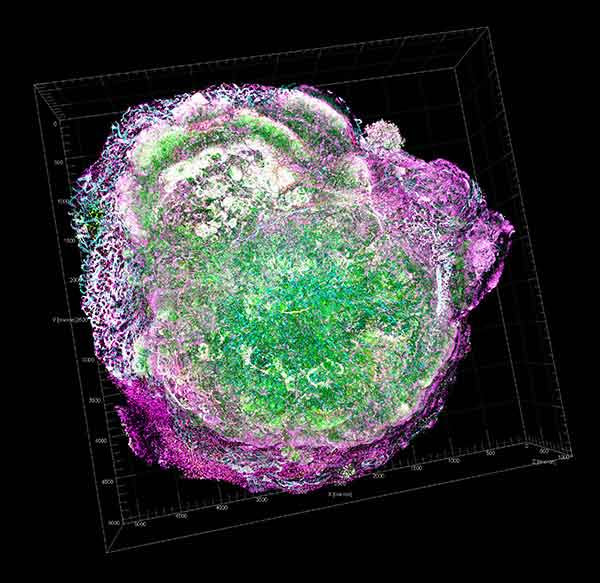 Single breast cancer cell and microenviornment visualized by transparent tumor tomography.