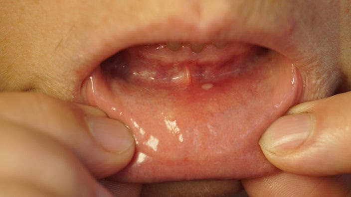 Close-up of a person pulling their bottom lip down to show an oral sore.