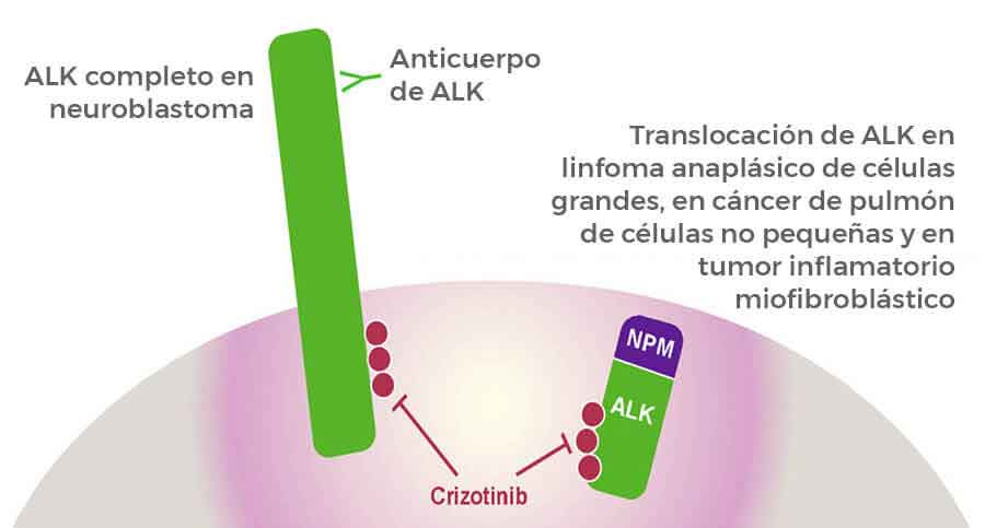 Crizotinib es prometedor para cánceres de la niñez