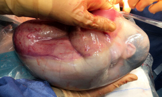 Magical Moment Shows Twin Girl Born Inside Amniotic Sac in 1-in-80,000 Rare Case