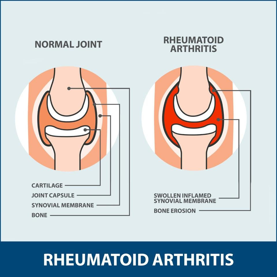 Rheumatoid arthritis joint