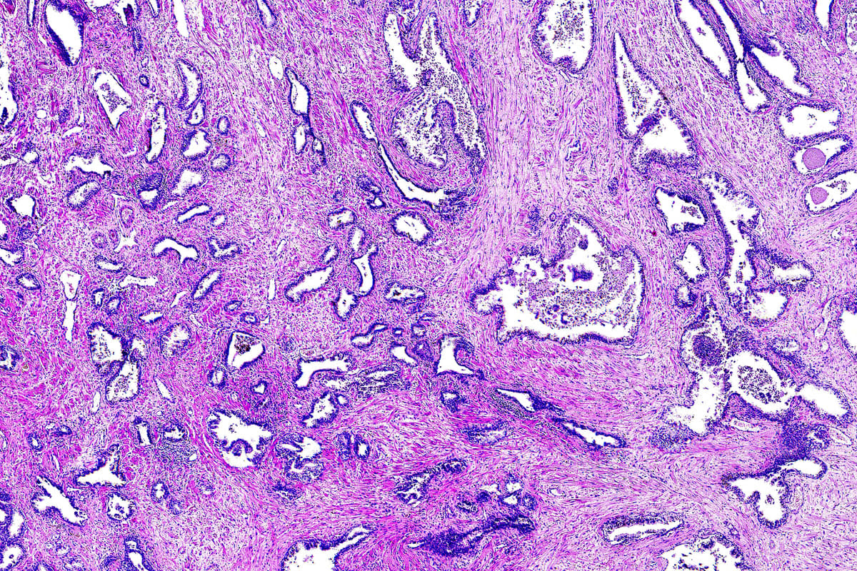 Researchers have found three new prostate cancer biomarkers that will assist pathologists to accurately grade the disease's severity