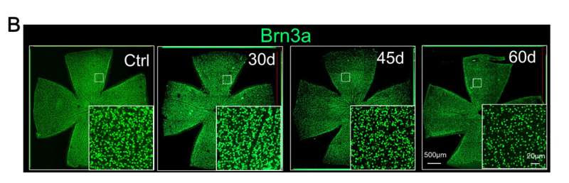 Association found between gut immune cells and eye damage from glaucoma