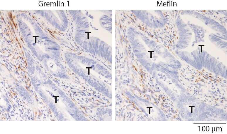 Study finds potential therapeutic targets to inhibit colorectal cancer progression