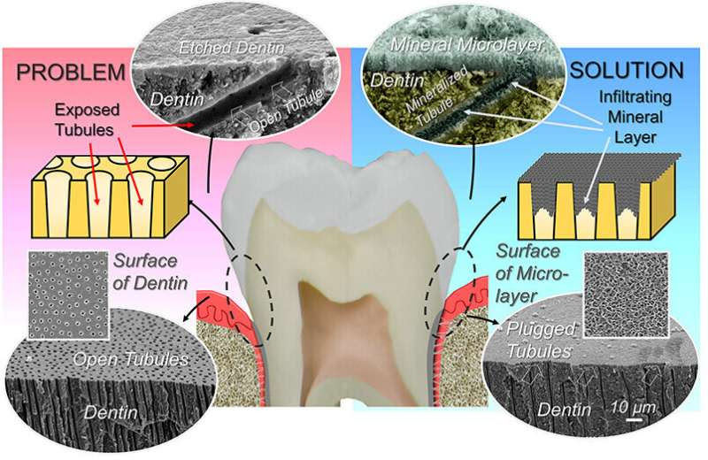 Dental lozenge could provide permanent treatment for tooth sensitivity