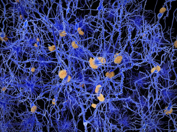 A computer illustration of amyloid plaques, characteristic features of Alzheimers disease.