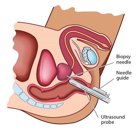 diagram of prostate cancer biopsy