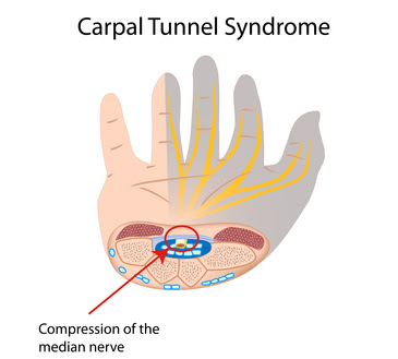 Carpal Tunnel Syndrome