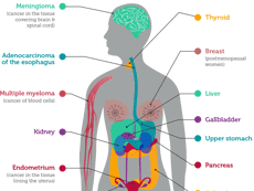 Infographic of Cancers Associated with Overweight and Obesity