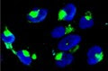 Nanoparticles in Glioma Cell Nuclei