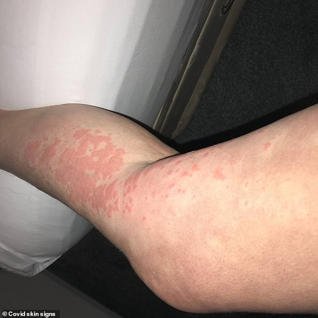 More than 400 people submitted images, which have now been published in an online database called Covid skin signs. The range of the rashes is astonishing, manifesting in hives (pictured) or raised lumps and seen across the entire body