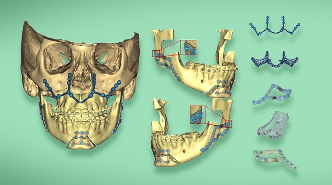  Reconstrucción mandibular en 3D, la medicina del futuro