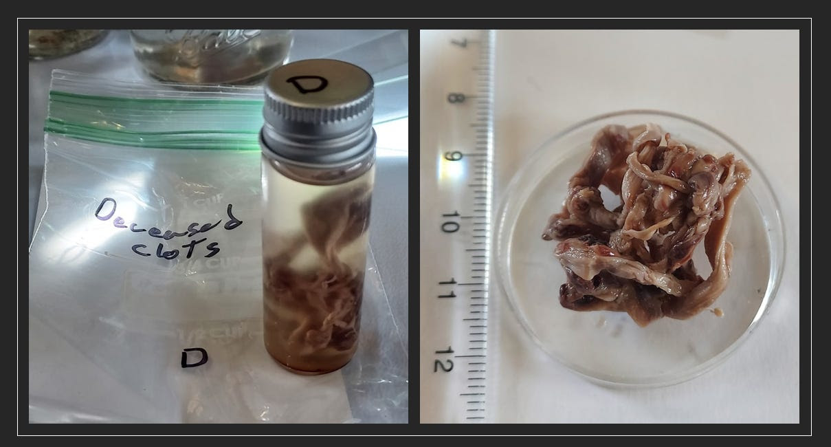 Blood Clot Analysis From Living And Deceased Individuals - Preliminary Chemical Solubility Testing - Part 3 of 3 - Dr. Ana Mihalcea With Clifford Carnicom