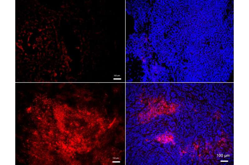 A common mechanism for cancer metastasis and atherosclerosis