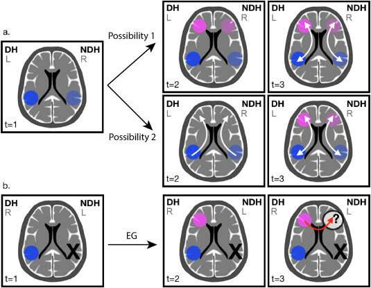 Woman born with no left temporal lobe developed a language network in the right side of her brain