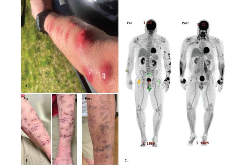 Single bacteriophage used to treat immunocompromised patient with antibiotic resistant infection