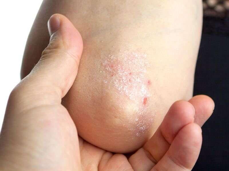 Tapinarof effective for longer-term treatment of plaque psoriasis