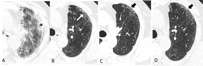 Chest CT Shows Lung Abnormalities Two Years after COVID