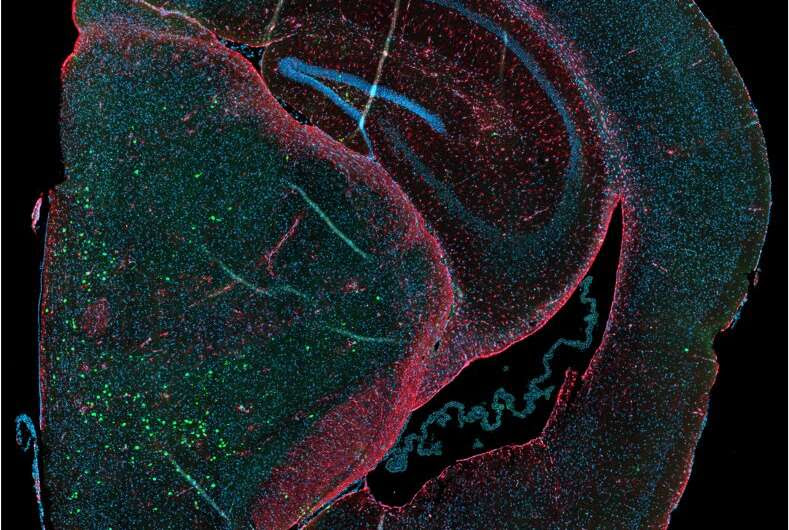 Protein mutation that causes Parkinson's may prevent another neurodegenerative disease