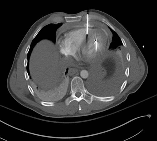 Chest CT scan of a nail gun injury that caused fluid to leak out of the pericardial sac