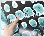 USC-led researchers release dataset of brain scans from stroke patients