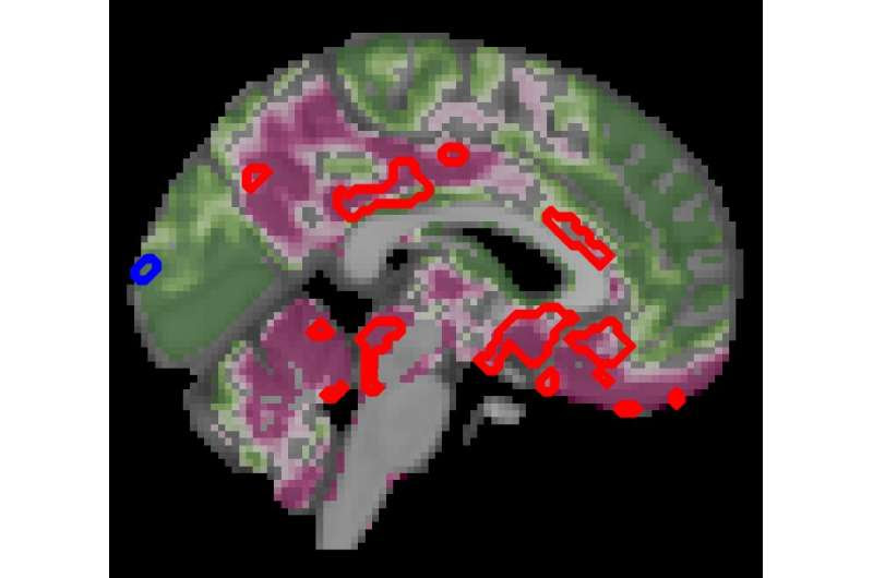 Type 2 diabetes accelerates brain aging and cognitive decline