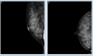 Chinese Mammography Database 