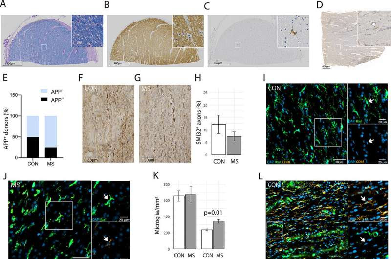 Multiple sclerosis: Ultrastructural changes in brain tissue promote inflammatory processes