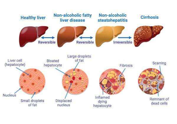 Uncovering the genetic causes of fatty liver disease — a growing health concern