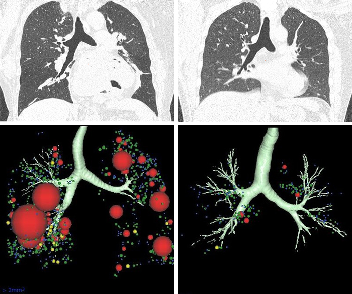 CT scans (top panels) and three-dimensional imaging (bottom panels) of asthmatics with (left panels) and without (right panels) fixed airflow obstruction (FAO)