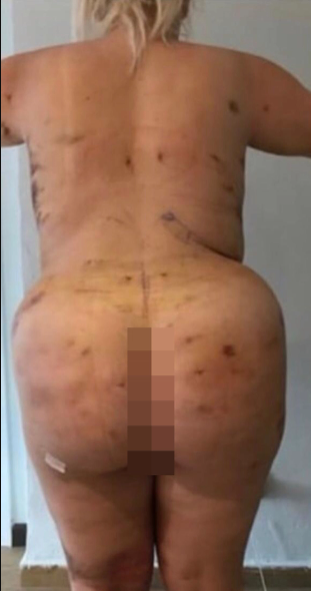 Woman, 23, ends up with a ?cone? butt after botched butt lift surgery in Turkey 