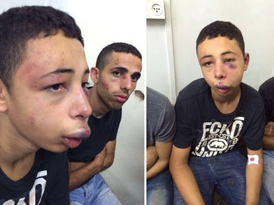 Fifteen-year-old Tariq Abukhdeir after Israeli police beat him. (Addameer)