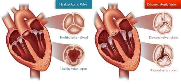 The sex of your cells matters when it comes to heart disease