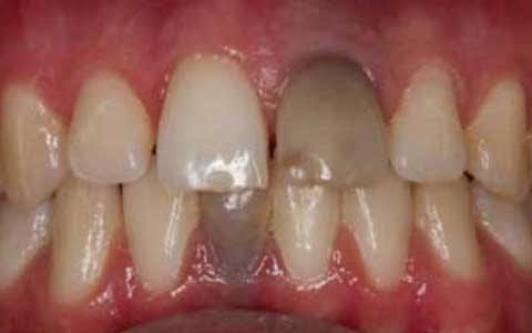 Răng chuyển sang đen có thể là dấu hiệu của bệnh ung thư miệng.