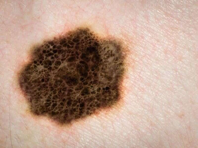 Tips to checking your skin for skin cancer