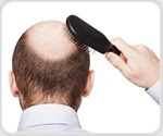 Study shows benefits of hair loss drug in improving cognitive function and vascular health